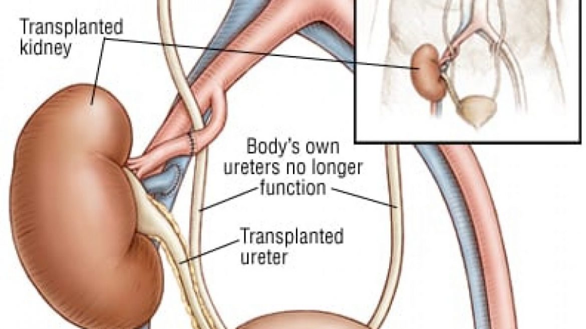 renal Transplant