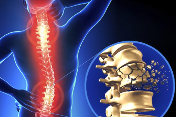 Spinal fractures in older people avoidable with simple X-ray method ...