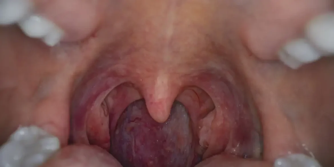 tonsil