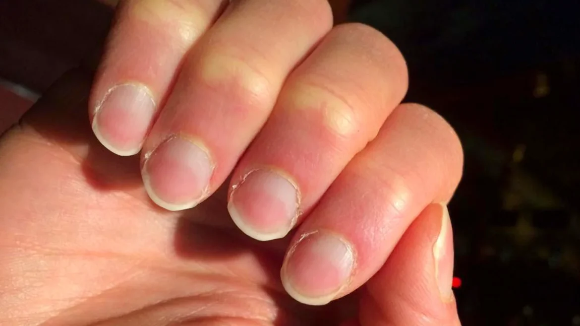 Unlock the Secrets of Your Health: What Your Nails Reveal About Hidden Diseases