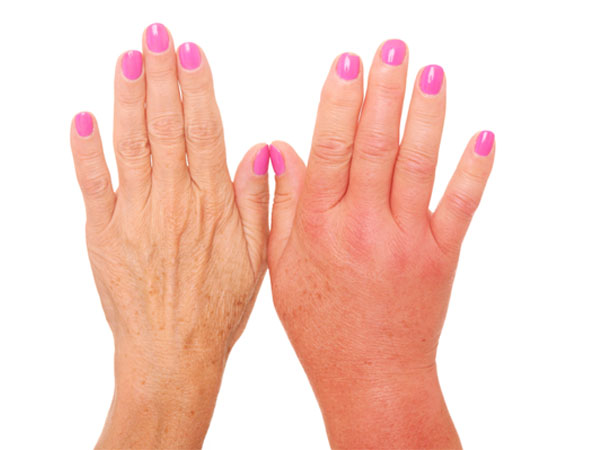 Silent Signs of Danger: How Swelling in Your Fingers Can Signal Kidney, Liver, or Heart Trouble