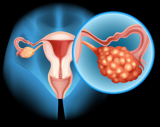 Watch Video: Experts Reveal the Silent Symptoms of Ovarian Cancer You Need to Know