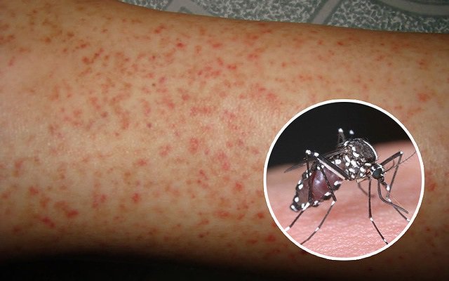 Dengue Got You Itching Like Crazy? Watch Video & Scratch the Mystery of Dengue Rash Relief!