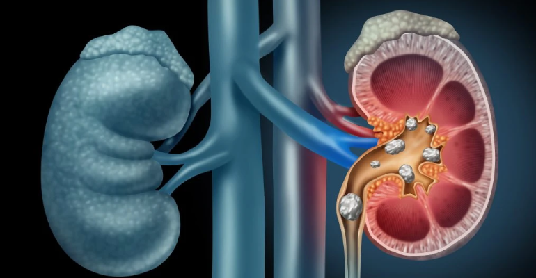 Prevent Kidney Stones Naturally: Watch Our Video for Essential Tips and Insights