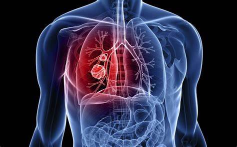 Lung Cancer: Beyond the Cigarette - Watch Video