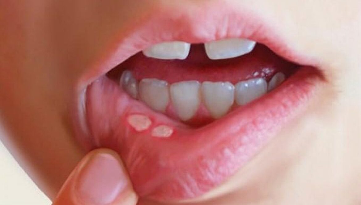 Conquer Mouth Ulcer Misery: Watch Video to Unravel Causes, Treatments & Prevention Hacks!