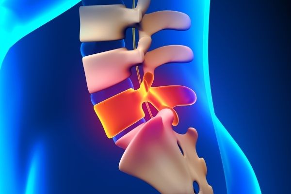 Understanding Slip Disc Bulge Treatment: The Ultimate Guide to Managing L4, L5 Slipped Discs