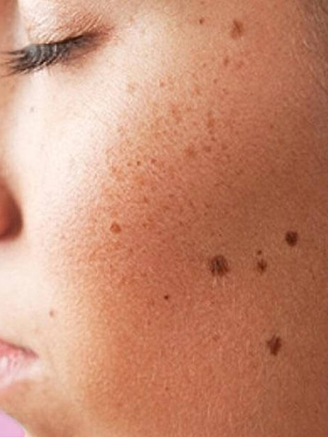 Glow Naturally: Top 6 Home Remedies for Dark Spots and Oily Skin