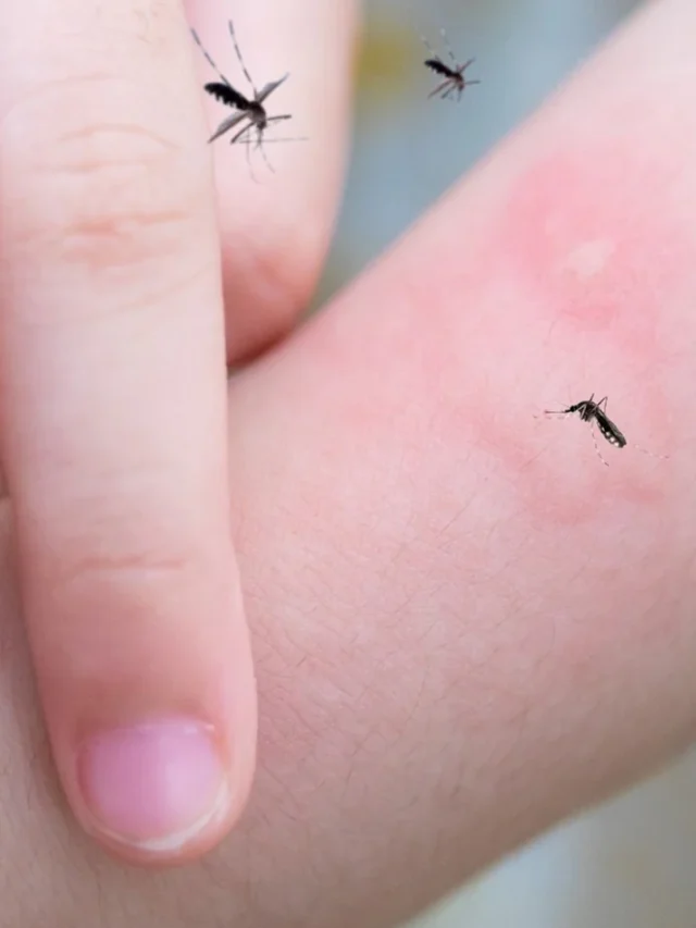 Instant Mosquito Bite Relief: 6 Home Remedies to Soothe Itch and Heal Your Skin