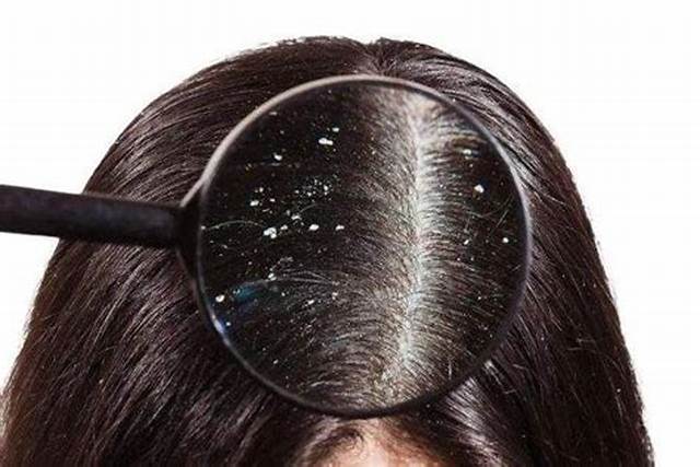 Watch This Video to Discover Effective Home Remedies for Dandruff and Understand Its Causes