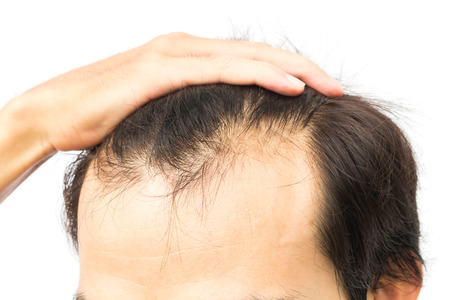 Watch Video: Discover the Causes of Hair Fall and How to Prevent Baldness