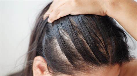 Video: Uncovering the Hidden Causes of Hair Fall—What Every Young Adult Needs to Know