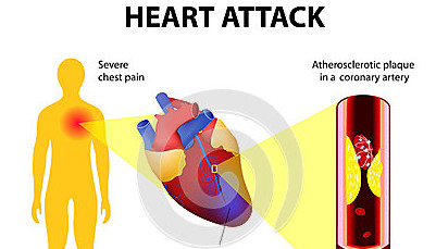 Watch Video: Uncover the Causes of Heart Attacks and How to Prevent Them