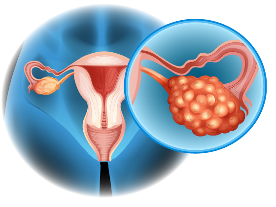 Watch Video: Discover the Causes, Symptoms, and Treatments of Uterine Fibroids