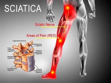 Watch Video: Uncover the Causes of Sciatica and Explore Effective Treatment Options