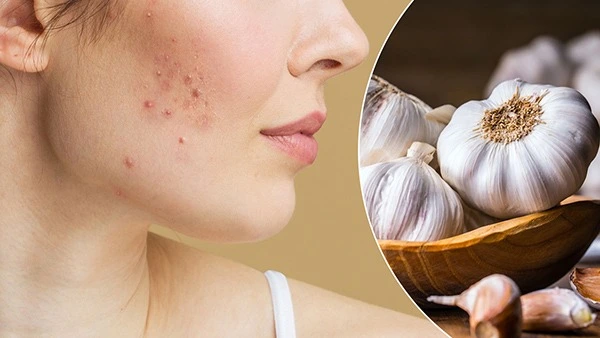 WATCH THE VIDEO: CAN GARLIC HELP REDUCE ACNE?