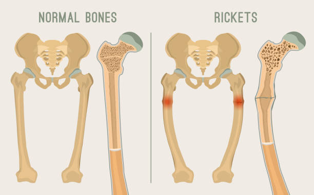 Watch This Informative Video on Rickets Disease: Causes, Prevention, and Expert Insights