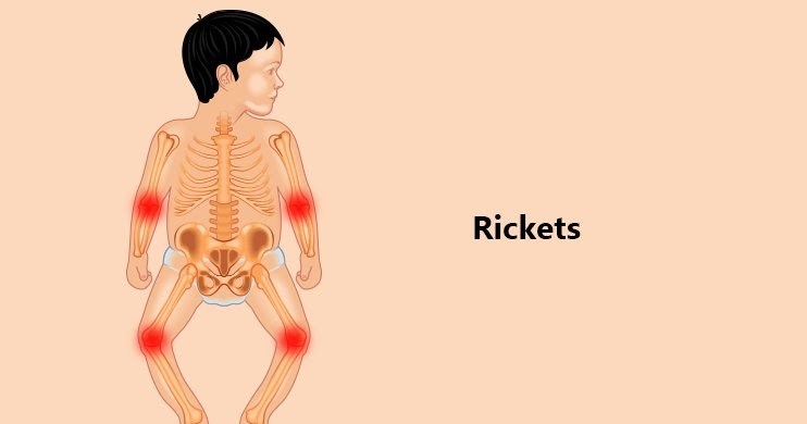 Watch Video: Essential Tips to Prevent Rickets in Children and Ensure Healthy Bone Development