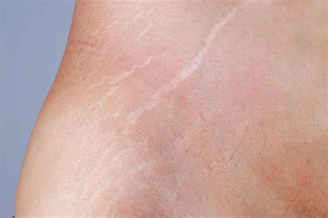 Watch Video: Discover Effective Ways to Prevent and Treat Stretch Marks for Beautiful Skin