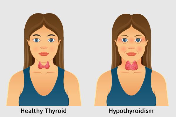 Early Morning Signs of Hypothyroidism Every Woman Should Watch Out For: A Comprehensive Guide to Recognize and Address Symptoms