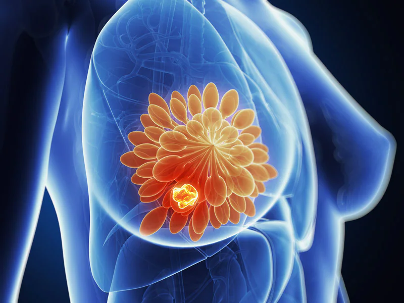 Triple Negative Breast Cancer: Risk Factors, Diagnosis and Treatment Options