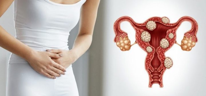 "Video: Foods Women with PCOS Must Avoid to Manage Symptoms Effectively!"