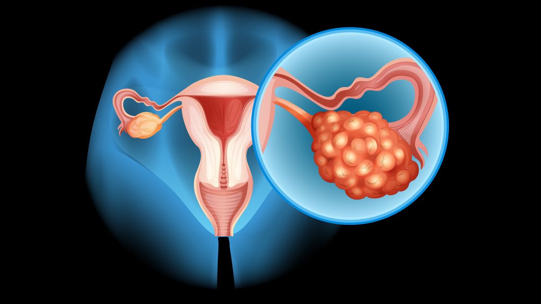 PCOS and Infertility: Symptoms, Prevention, and Treatment for Women's Health