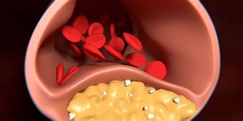 "Bad Cholesterol: How It Harms Your Body and Simple Ways to Control It"