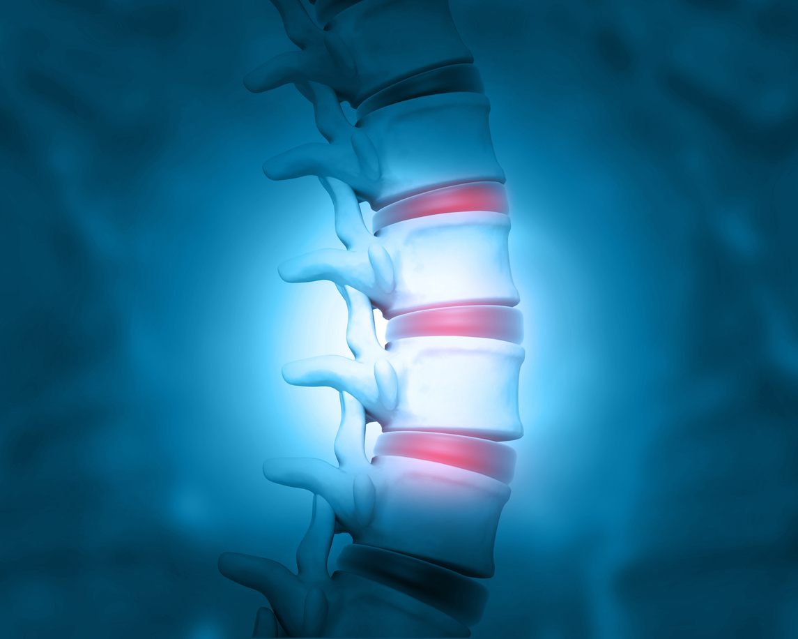 Slipped Disc: Causes, Symptoms, and Tips to Protect Your Spine