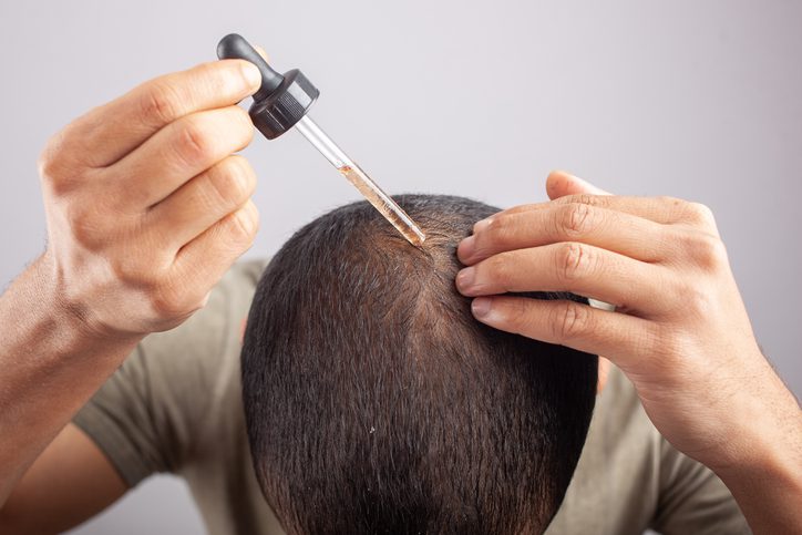 "New Guidelines Recommend Oral Minoxidil for Most Adults with Hair Loss: A Game Changer in Hair Regrowth Treatment"