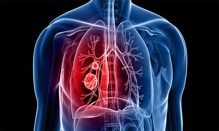 "Lung Cancer: Understanding Causes, Symptoms, and Prevention for a Healthier Future"