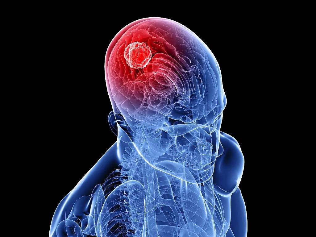 Morning Headaches: A Potential Warning Sign of Brain Tumors