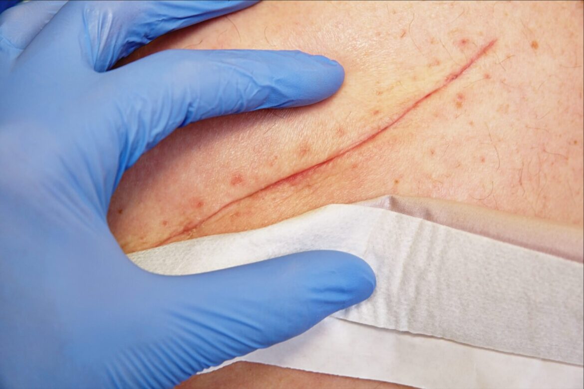 Battle Surgical Site Infections: Causes, Symptoms & Prevention Unveiled!